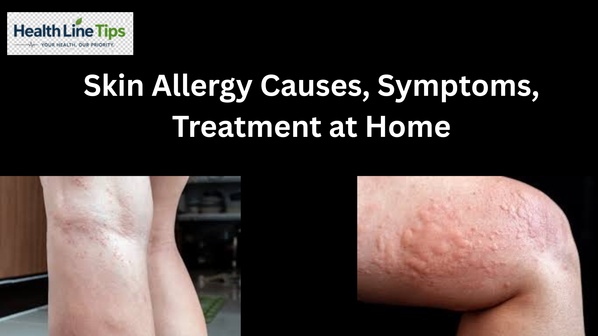 Skin Allergy Causes, Symptoms, Treatment at Home